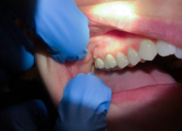 Best Emergency Tooth Extraction in Reading, MI